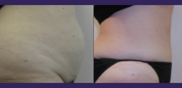 Tummy Tuck Before and After results 3