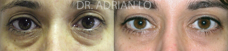 Eyelid surgery actual patient results 2