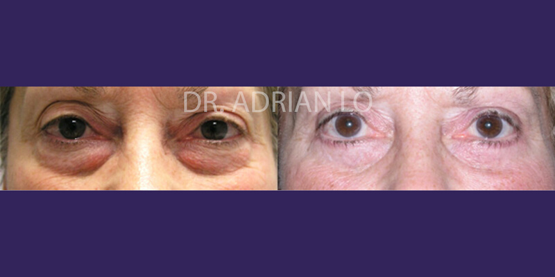 Eyelid surgery actual patient results 2