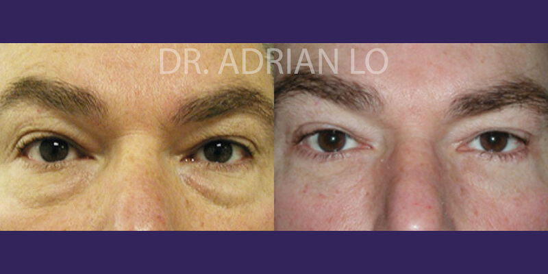 Eyelid surgery actual patient results 3