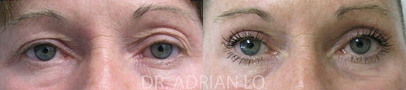 Eyelid surgery actual patient results