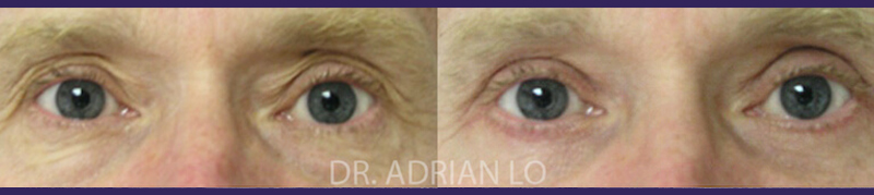 Eyelid surgery actual patient results 3