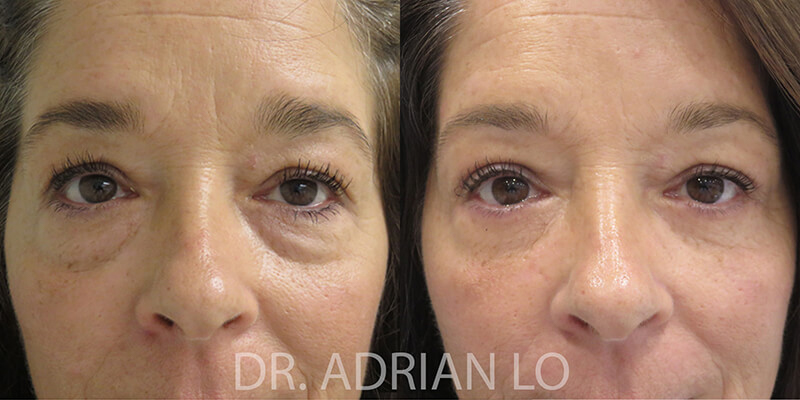 Eyelid surgery actual patient results