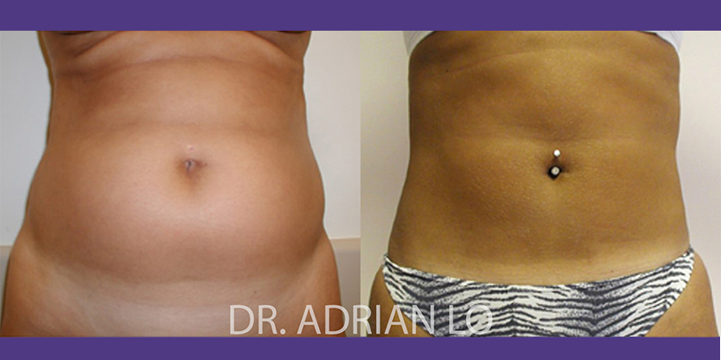 Liposuction actual patient results