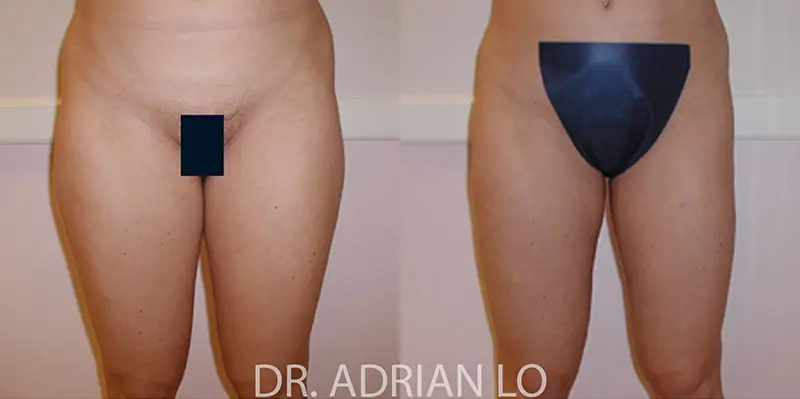 Liposuction actual patient results 2