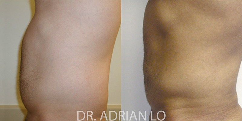 Liposuction actual patient results 3