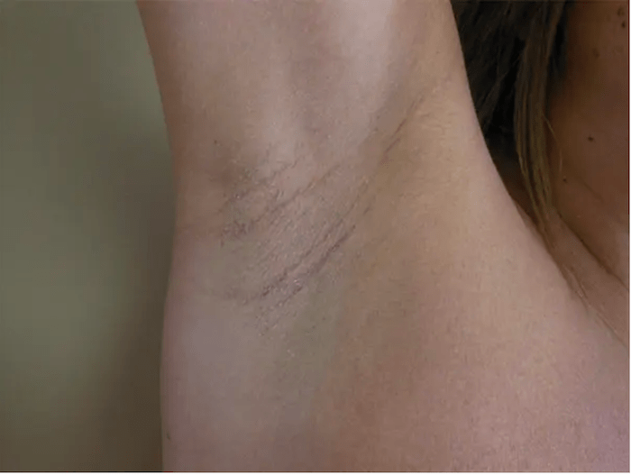 Armpit scar resulting from a transaxillary breast enhancement.