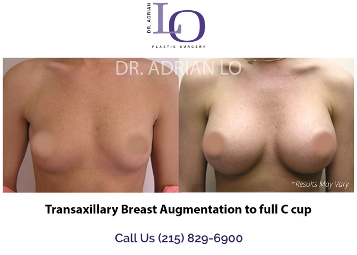 Before and after imaging showing the results of a scarless breast augmentation performed in Philadelphia, PA.