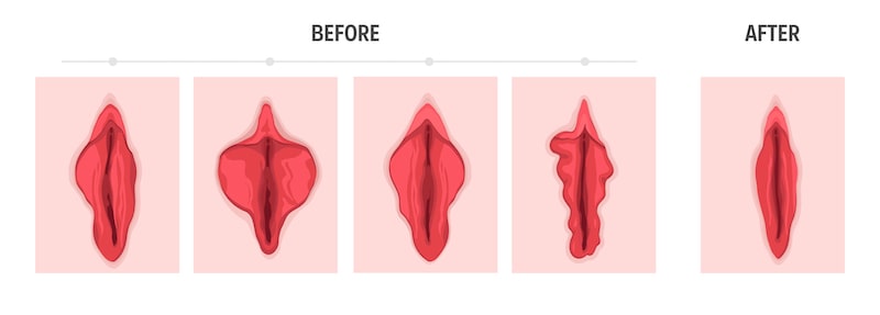 illustration of enlarged labia before and after labiaplasty.