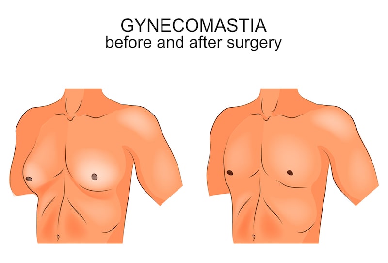 Illustration showing before and after gynecomastia surgery.