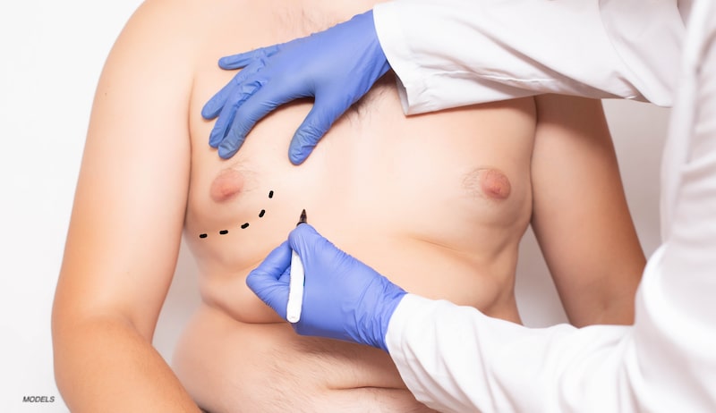Plastic surgeon drawing surgical marks on a shirtless man with gynecomastia
