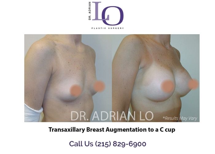 Before and after image showing the results of a scarless breast augmentation performed in Philadelphia, PA.
