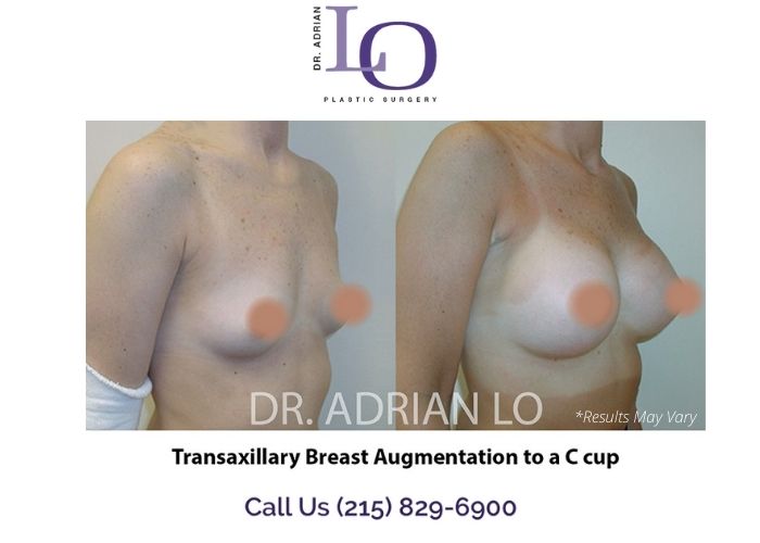 How Big Can My Implants Be With Scarless Breast Augmentation? -  Philadelphia, PA - Dr. Adrian Lo Plastic Surgery