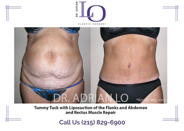 Before and after image showing the results of a tummy tuck performed in Philadelphia, PA.
