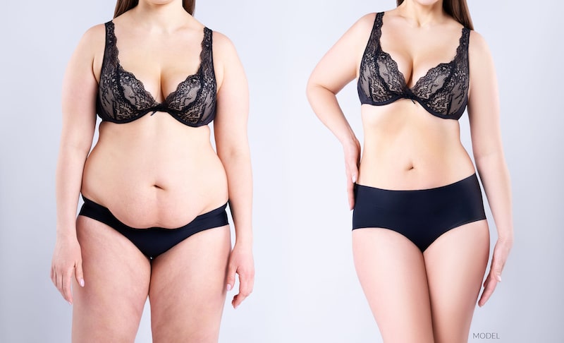 Model concept before and after weight loss or body contouring surgery.