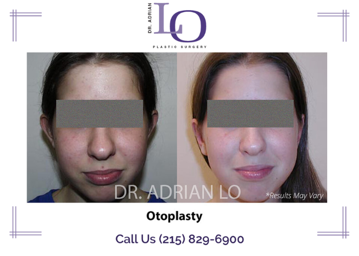Before and after image showing the results of an otoplasty performed in Philadelphia, PA.