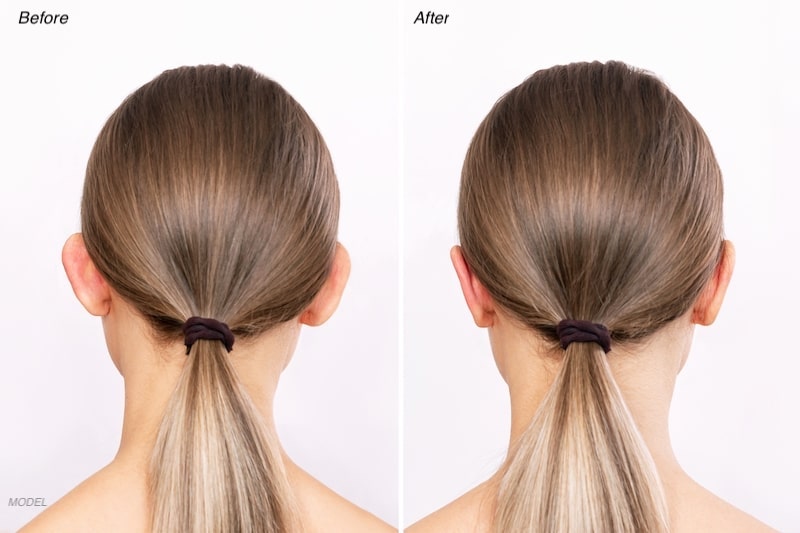 Two images of the rear view of a young woman's head, before and after her ear surgery