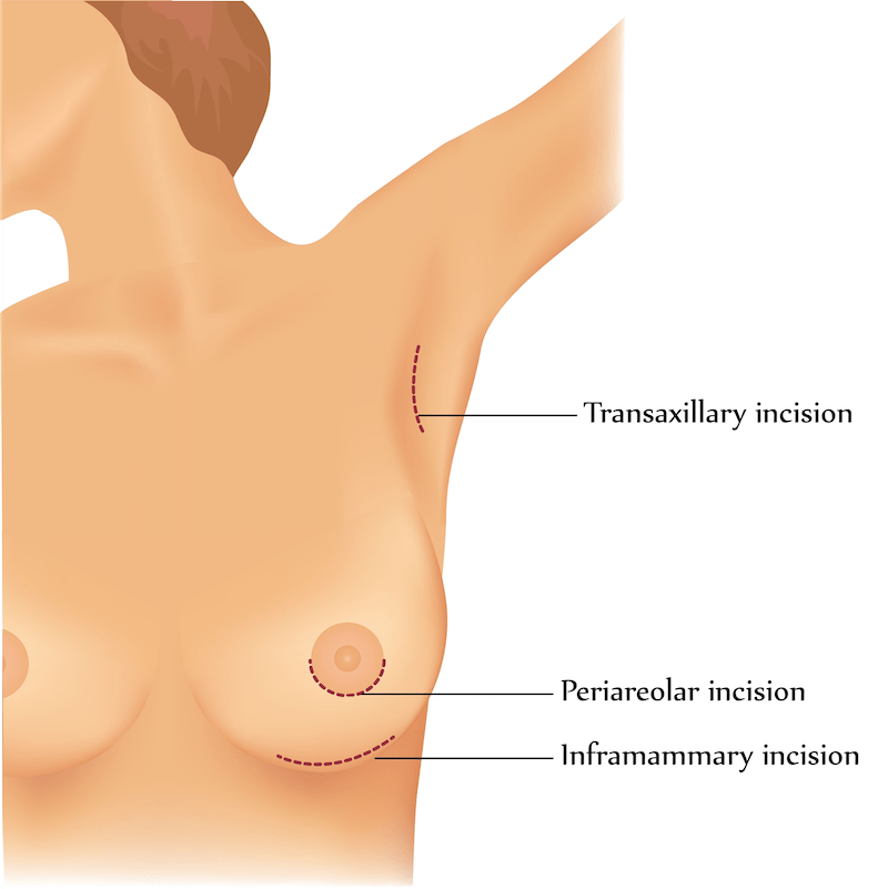 Illustration of breast augmentation incision options.