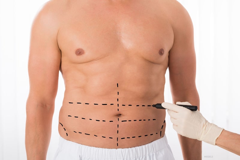 Close up of a man's midsection as a plastic surgeon makes surgery lines on his stomach