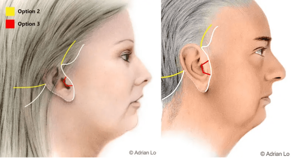 Illustration of where facelift incisions will be made.