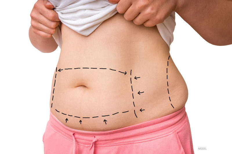 Woman's midsection with surgical lines and arrows on her skin for a tummy tuck.