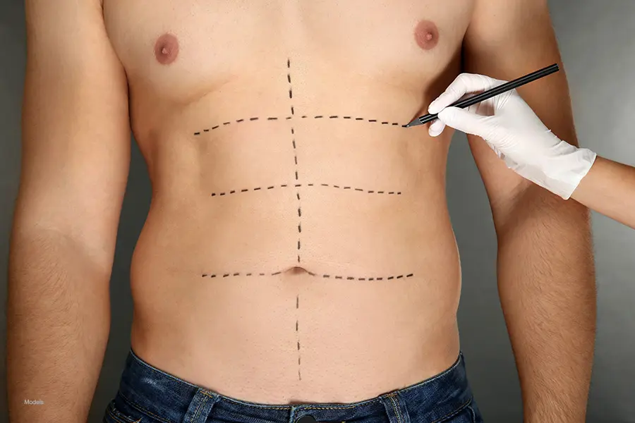 Plastic surgery concept. Female hand marking male belly before operating Man with lines drawn over his abs