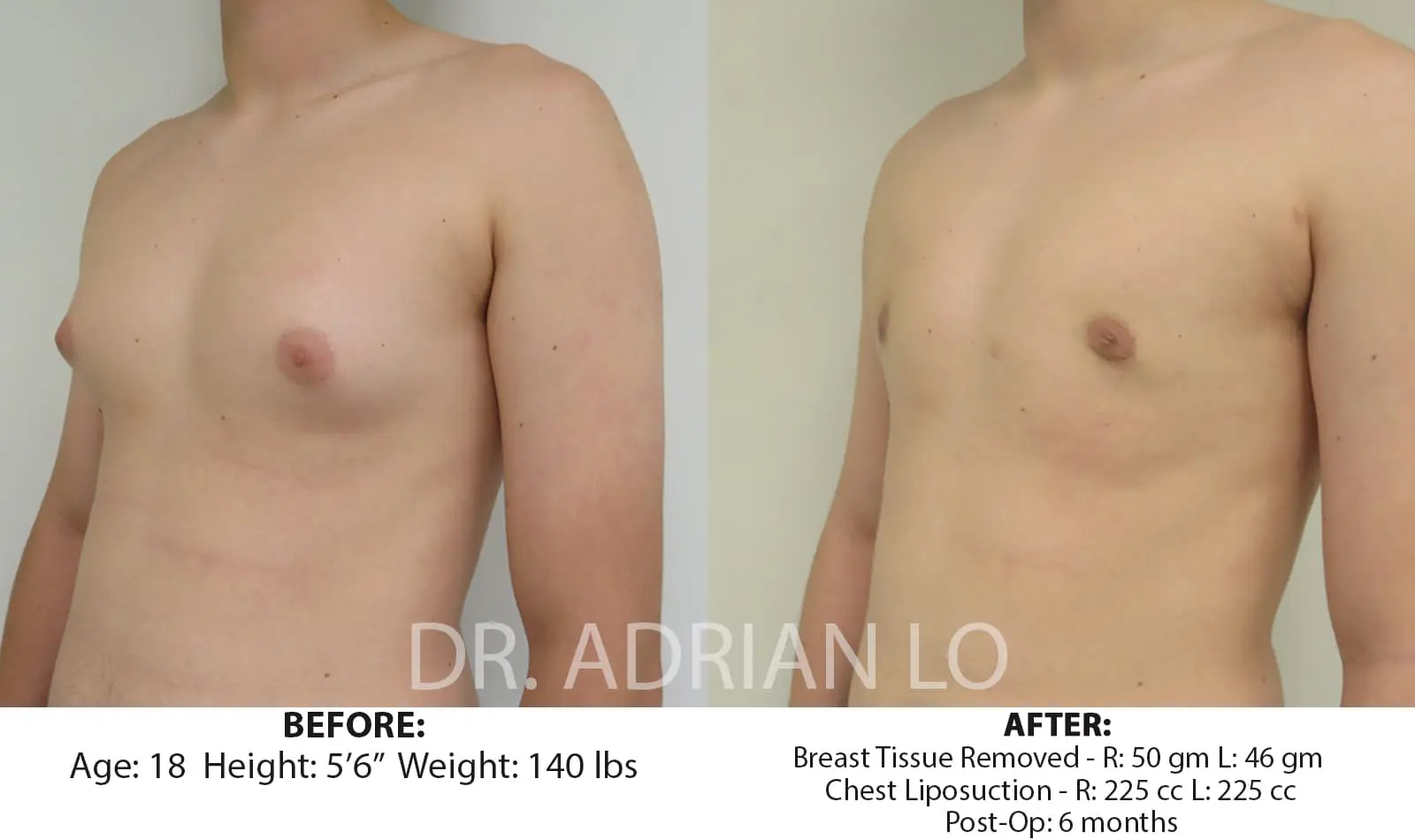 Gynecomastia in Adolescents: Effects, Presentations & More - Philadelphia,  PA - Dr. Adrian Lo Plastic Surgery