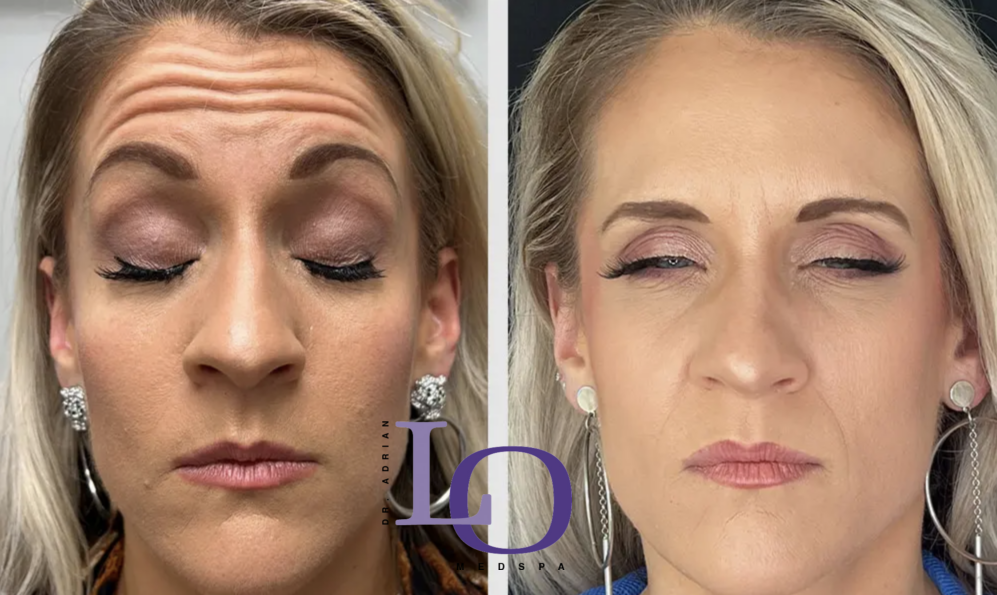 Botox® Cosmetic Before and After Patient 1
