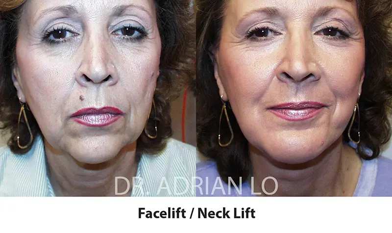 LO - facelift scars