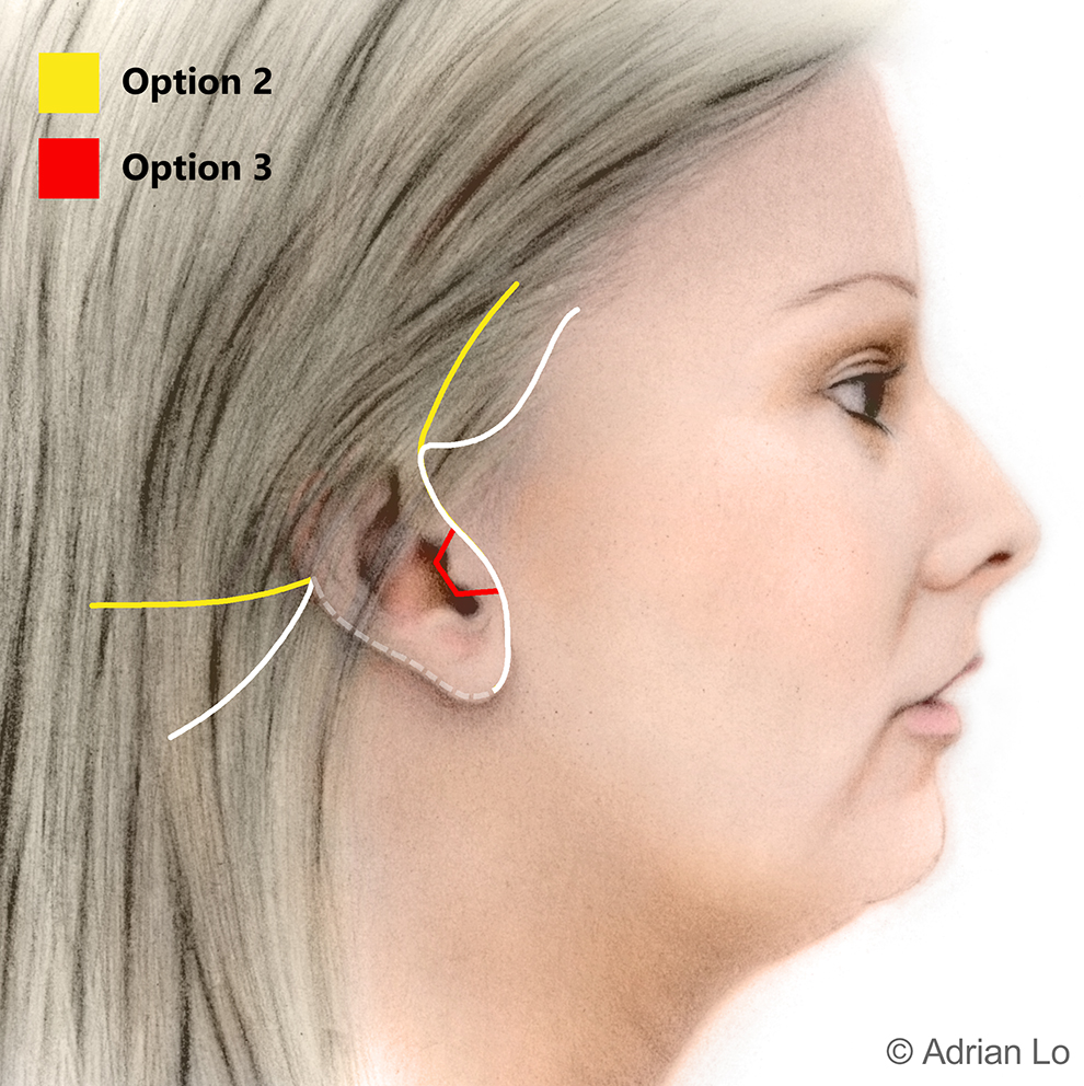 FACELIFT SCARS Jowls Surgery INCISION