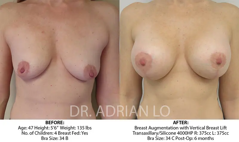 Lo - breast-aug-lift-2 Before & Aftera
