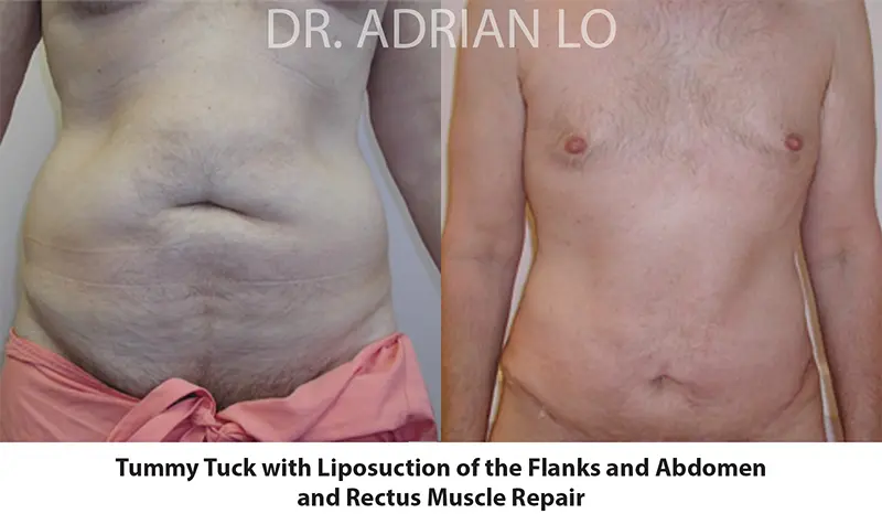 Lo - men tummy tuck before and after - male