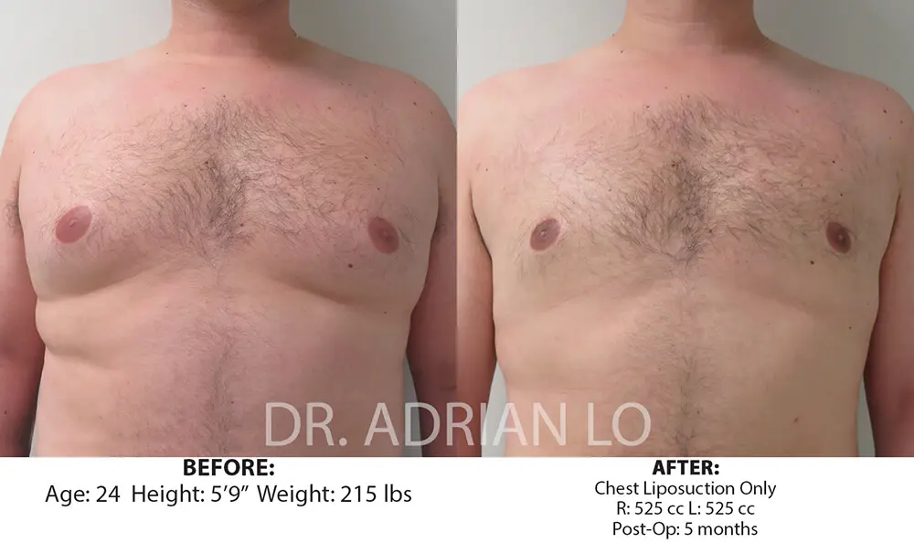 man before and after Pseudogynecomastia