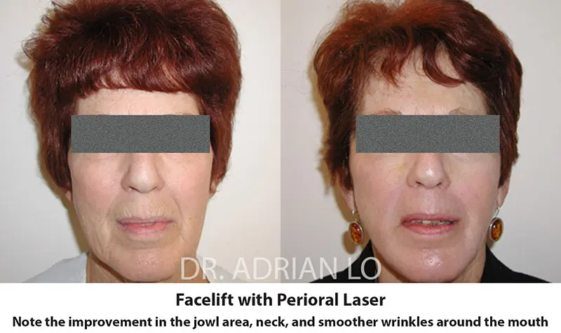 Facelift Recovery Time before and after
