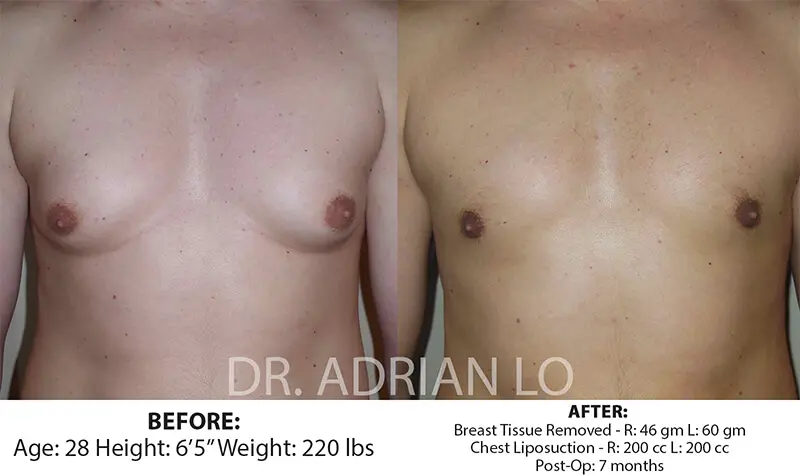 LO - Gynecomastia Before and afte