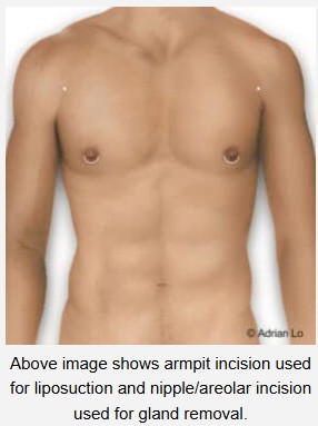 Pseudogynecomastia