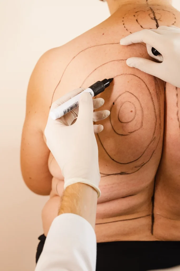 back liposuction