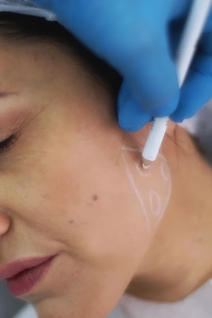 non surgical jawline contouring