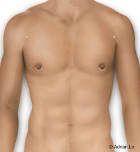 Lo- Gynecomastia incisions