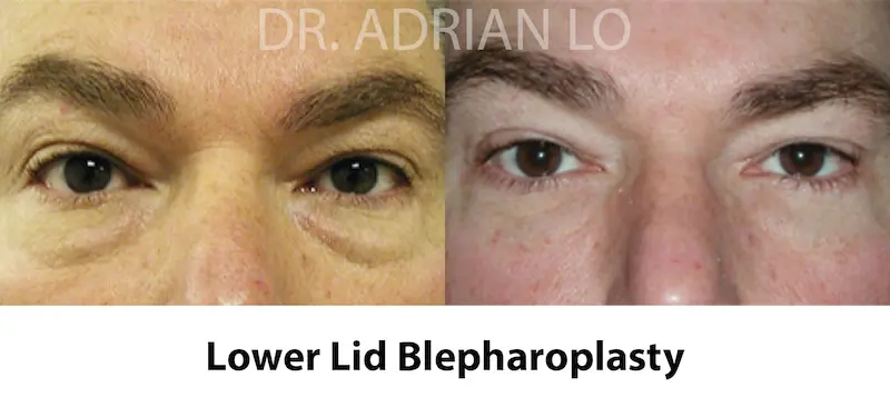 Lo - LOWER eyelid-sugery-15 before and after
