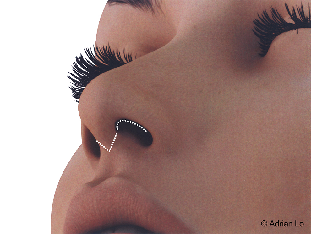 Lo - Rhinoplasty anatomy