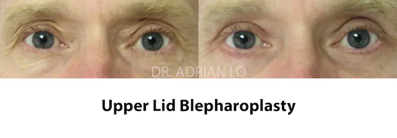 Lo UPPER eyelid-sugery