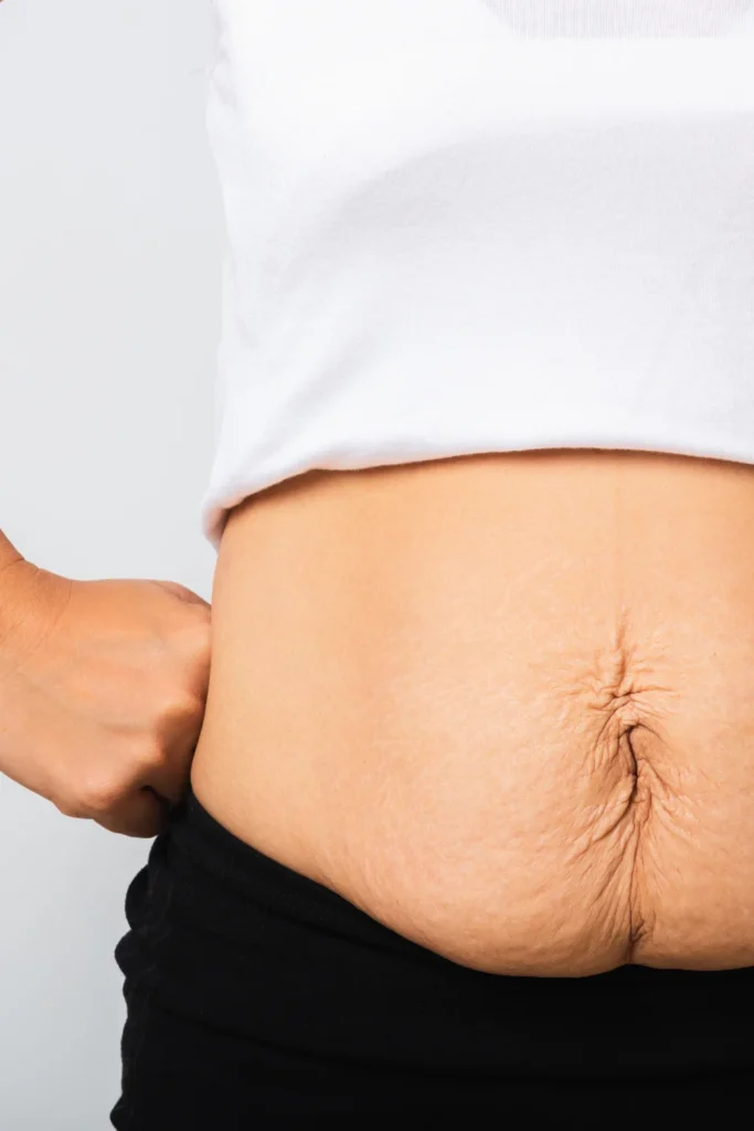 how to tighten loose skin after weight loss