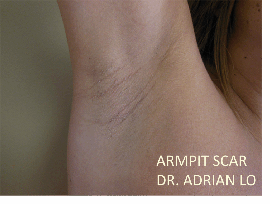 Lo - Breast Augmentation Transaxillary Armpit Scar