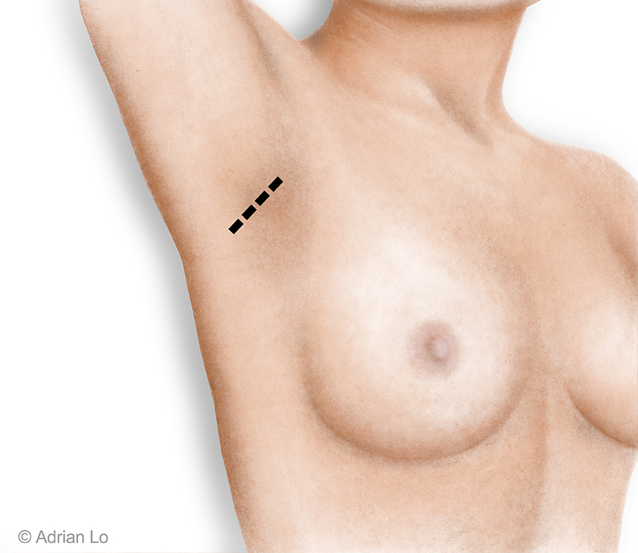 Underarm_incision_CLIENT FINAL
