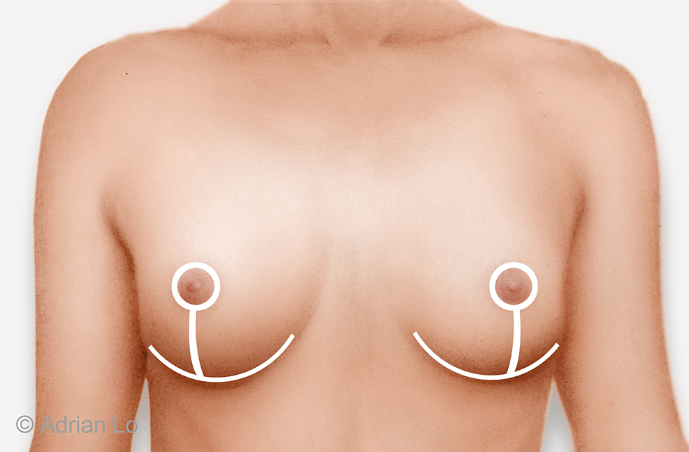 Frontal_chest_Anchor Inverted T Lift