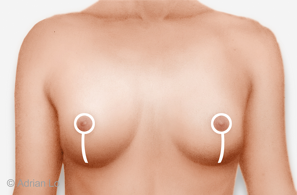 Frontal_chest_Vertical Lollipop Lift