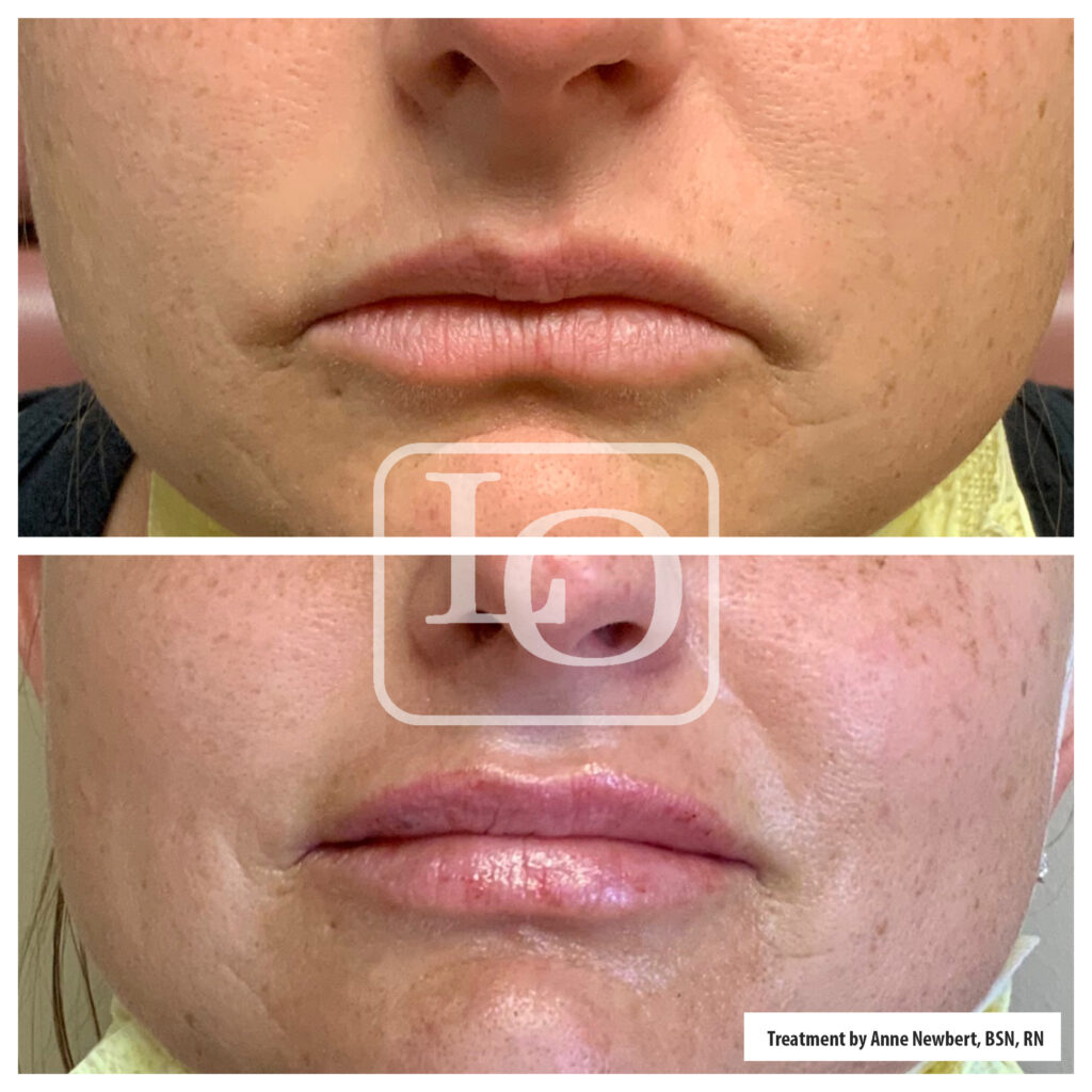 LO- Botox Marionette before and after lips