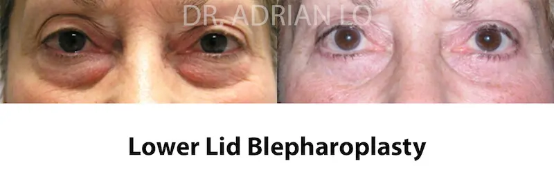 LO eyelid-sugery-13 before and after