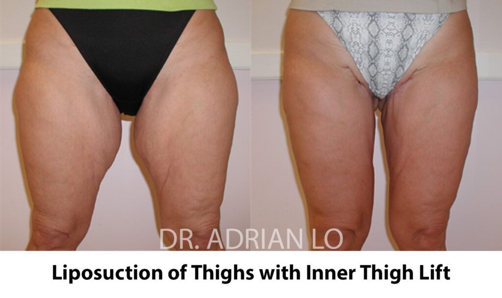 Lo - Inner Thigh Lift